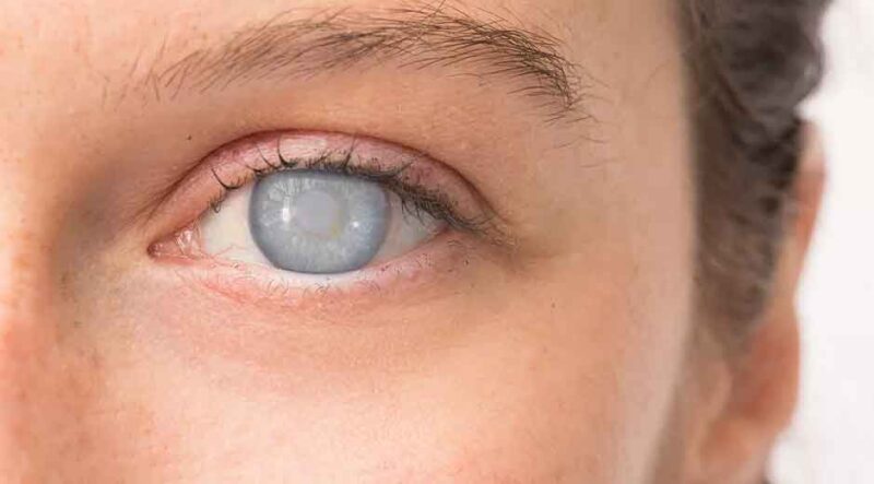 What Are Cataracts and How Are They Treated?