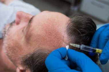 What-Are-the-Long-Term-Benefits-of-FUT-Hair-Transplants