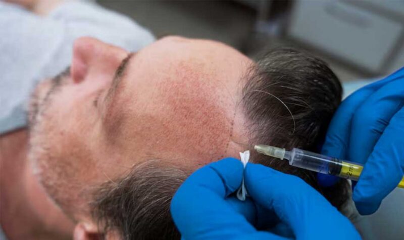 What-Are-the-Long-Term-Benefits-of-FUT-Hair-Transplants