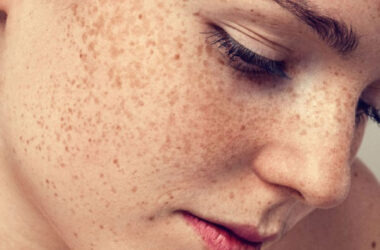 Does Hyperpigmentation Ever Really Go Away