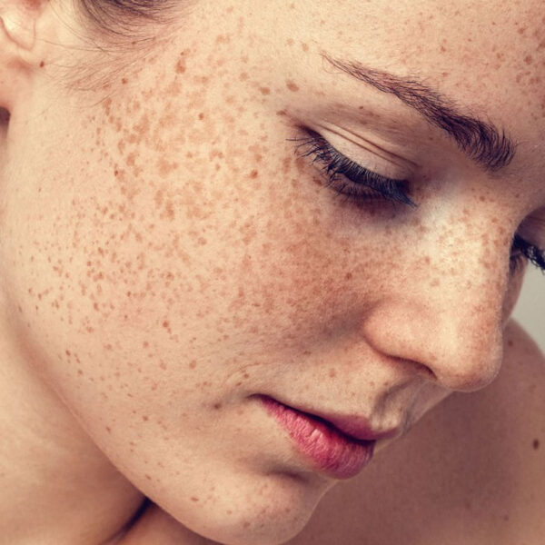 Does Hyperpigmentation Ever Really Go Away